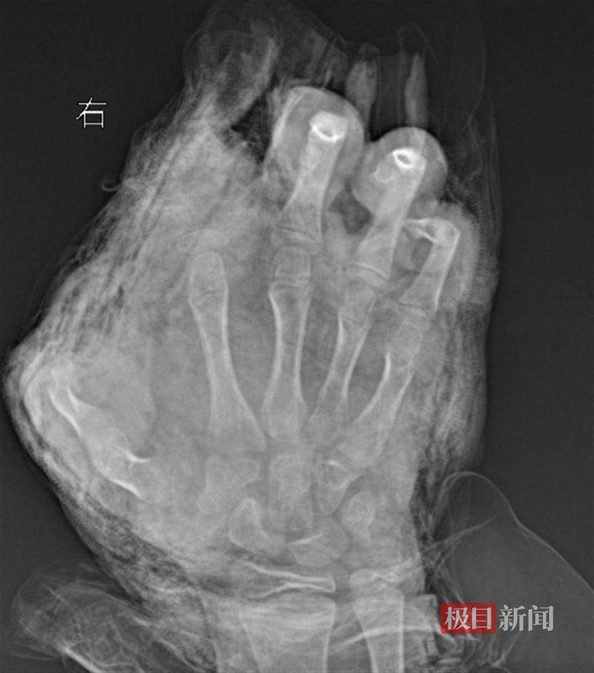 痛心!用火药粉自制“鞭炮”,12岁男孩被炸断三根手指