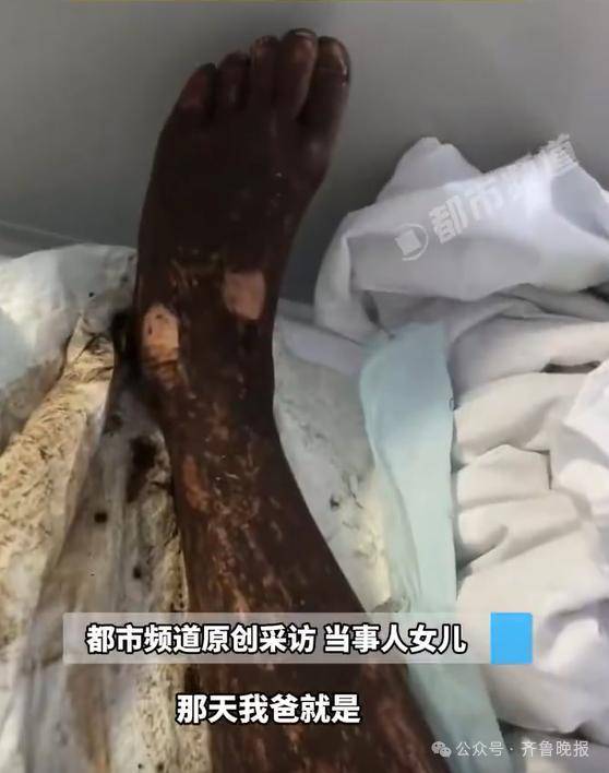 安徽宣城一男子走路玩手机,一脚踩中打架的竹叶青和五步蛇,被俩毒蛇咬3口!医院:暂无生命危险,正在治疗