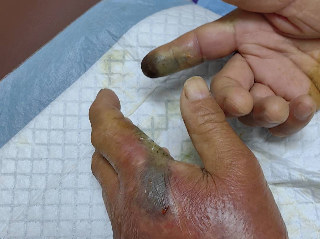 眼镜王蛇咬伤老人，家属拖两米多长的“凶手”冲进医院！“拎蛇就医”可取吗？