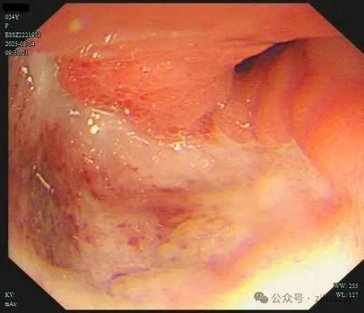 24岁女演员确诊“癌王”，崩溃痛悔：大家别像我这样