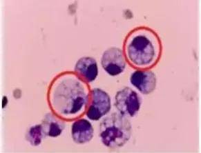 24岁女演员确诊“癌王”，崩溃痛悔：大家别像我这样